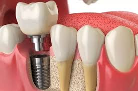 Implantes dentales
